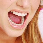 Sistema de Brackets Incognito™ Lite