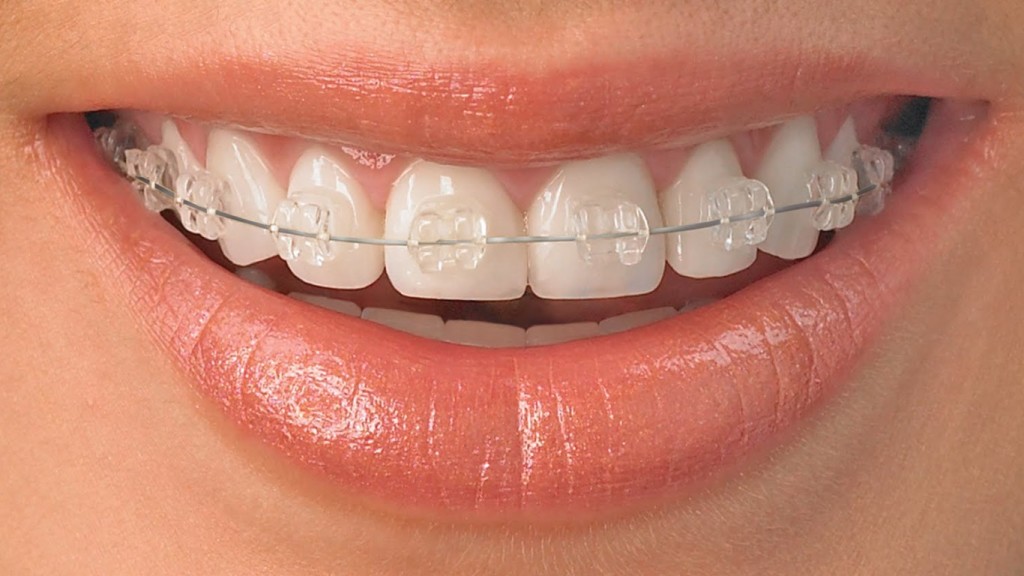 clear-orthodontic-braces-1366x768