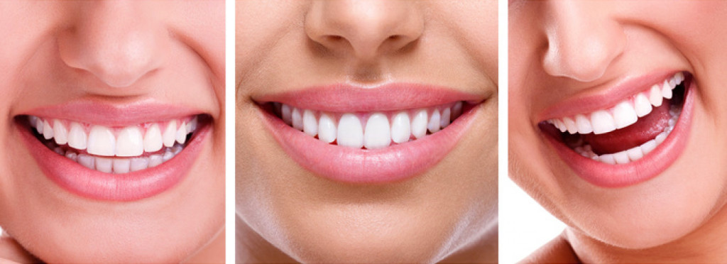 blaqueamiento-dental